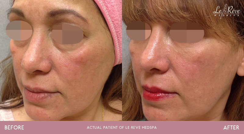 Before and after Juvederm photos