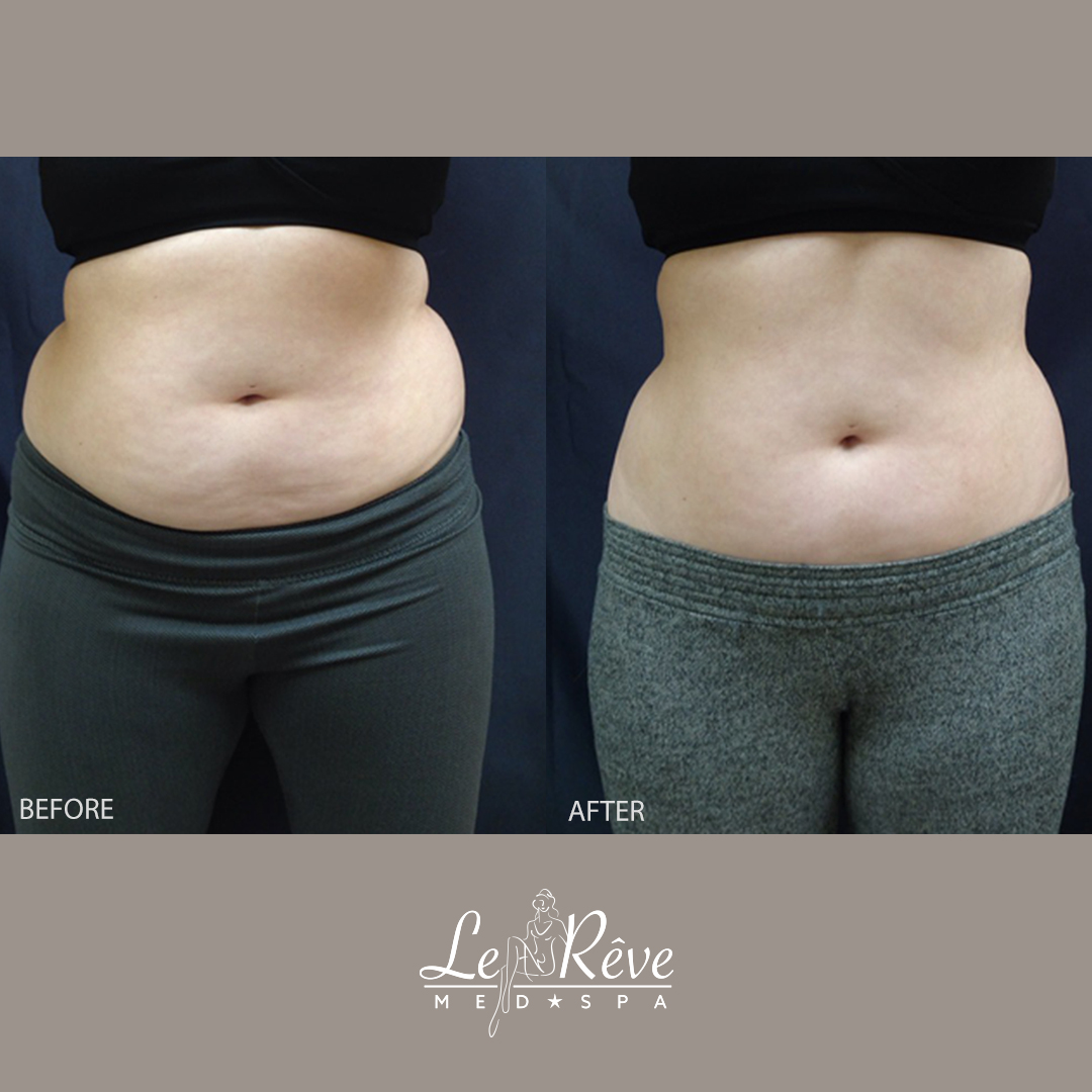 Before and after Velashape photos