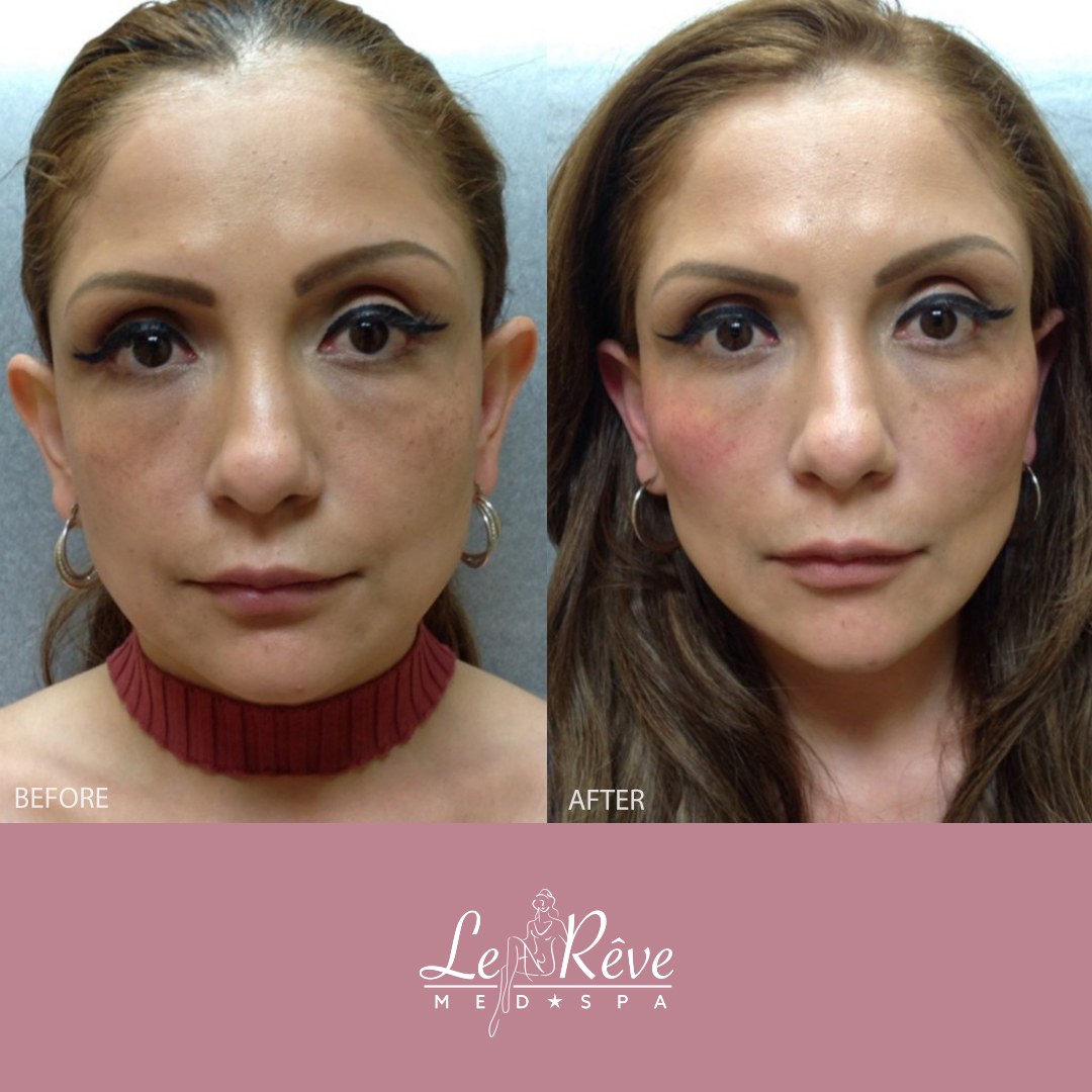 Before and after Voluma photos