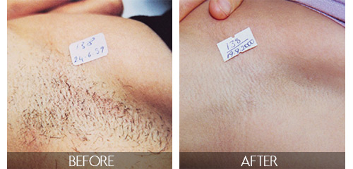 painless laser hair removal