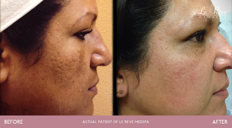 Before and after facial rejuvenation treatments