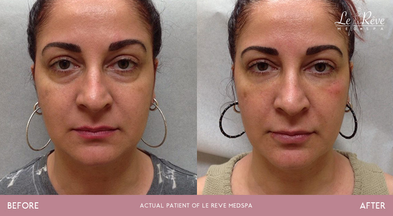 Before and after Restylane treatments