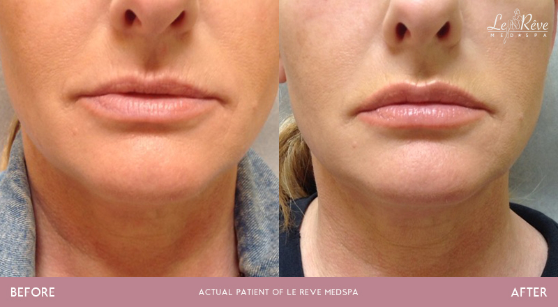 before and after lip augmentation