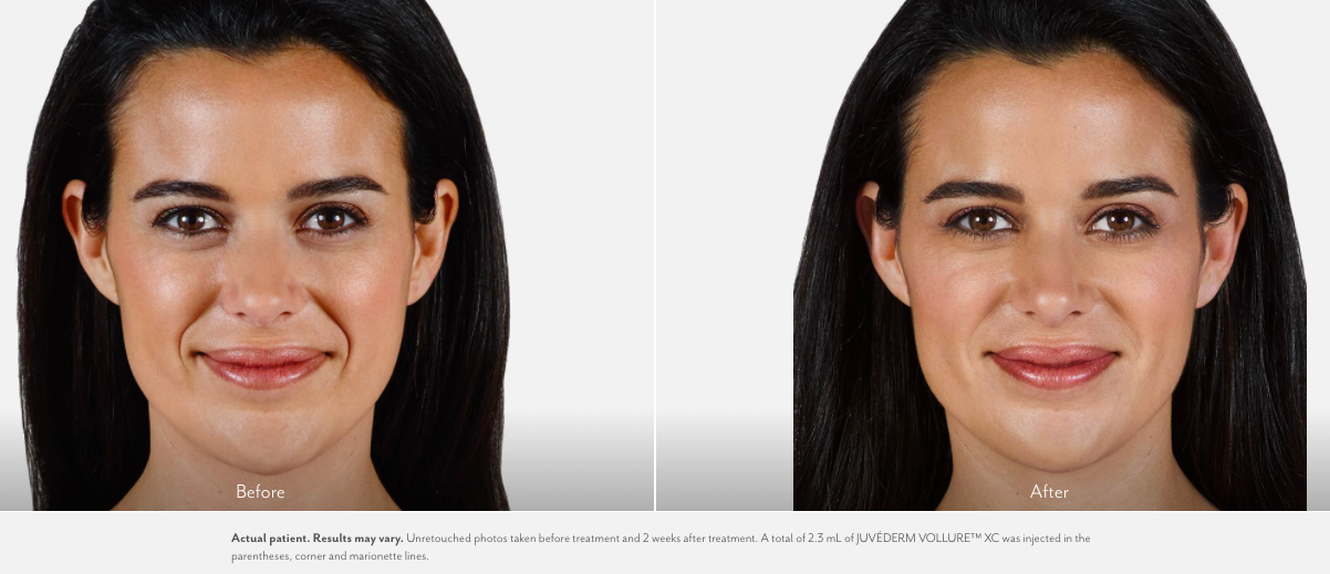 Before and after Juvederm results