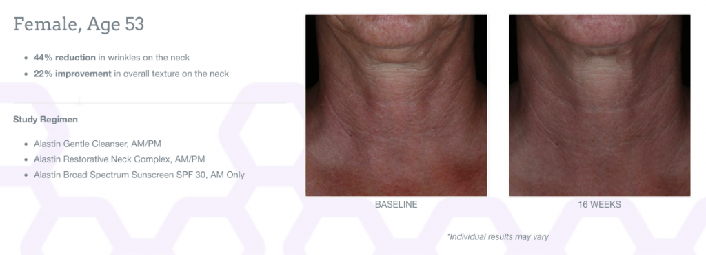 restorative neck complex before and after photos