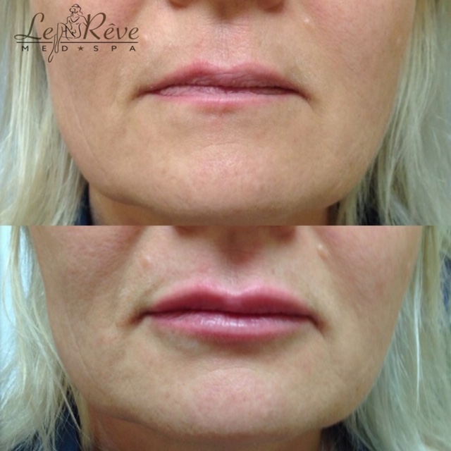 Before and after Volbella treatments