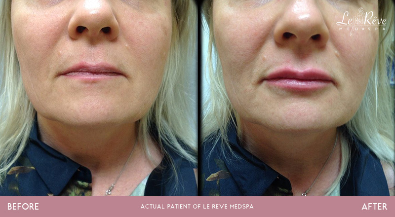 Before and after Juvederm results