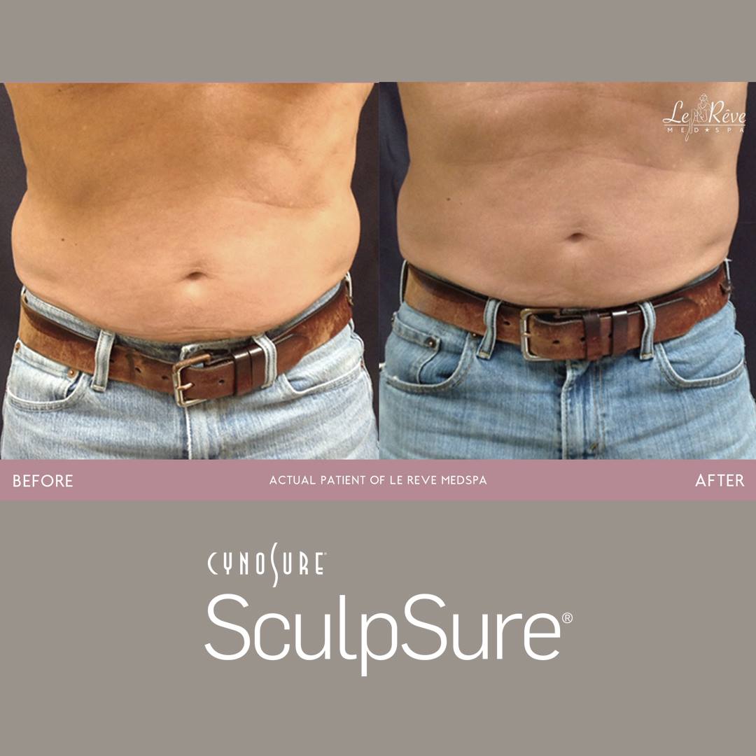 before and after SculpSure