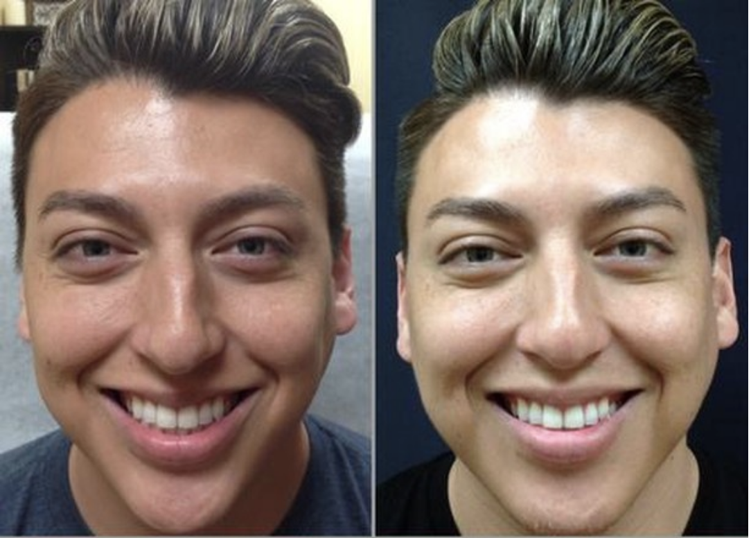 Before and after Brotox