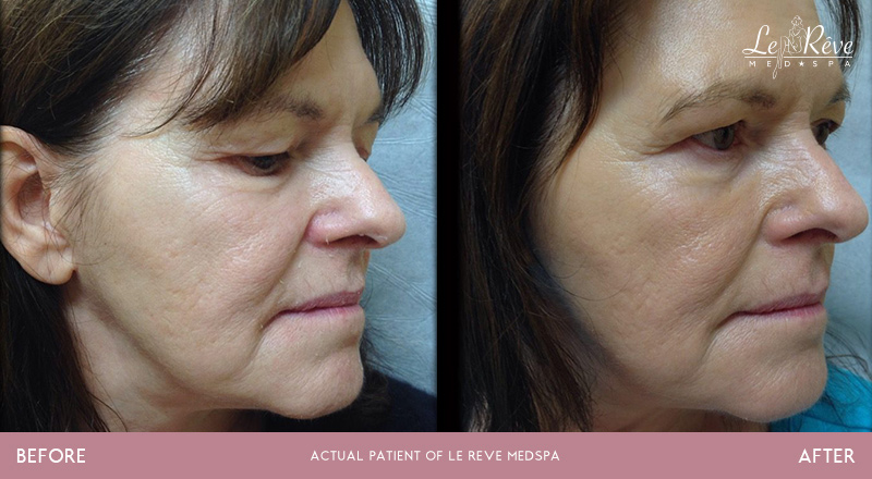 Before and after AquaGold treatments