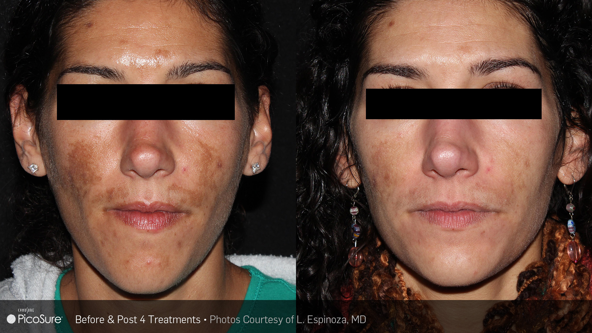 PicoSure before and after results