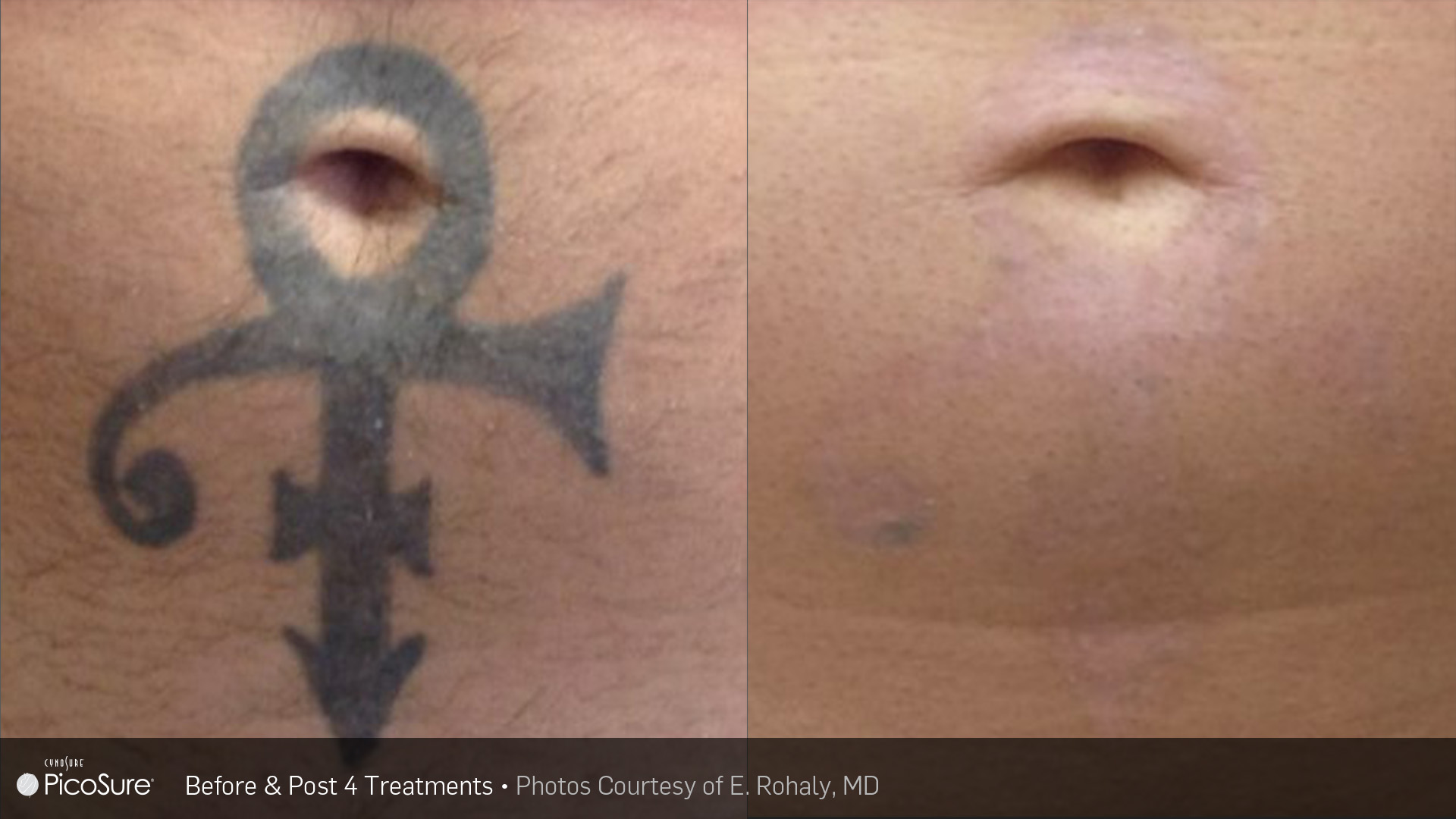 PicoSure tattoo removal before and after