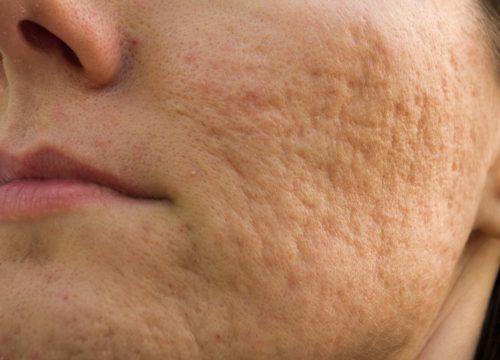 Acne scars on a woman's face