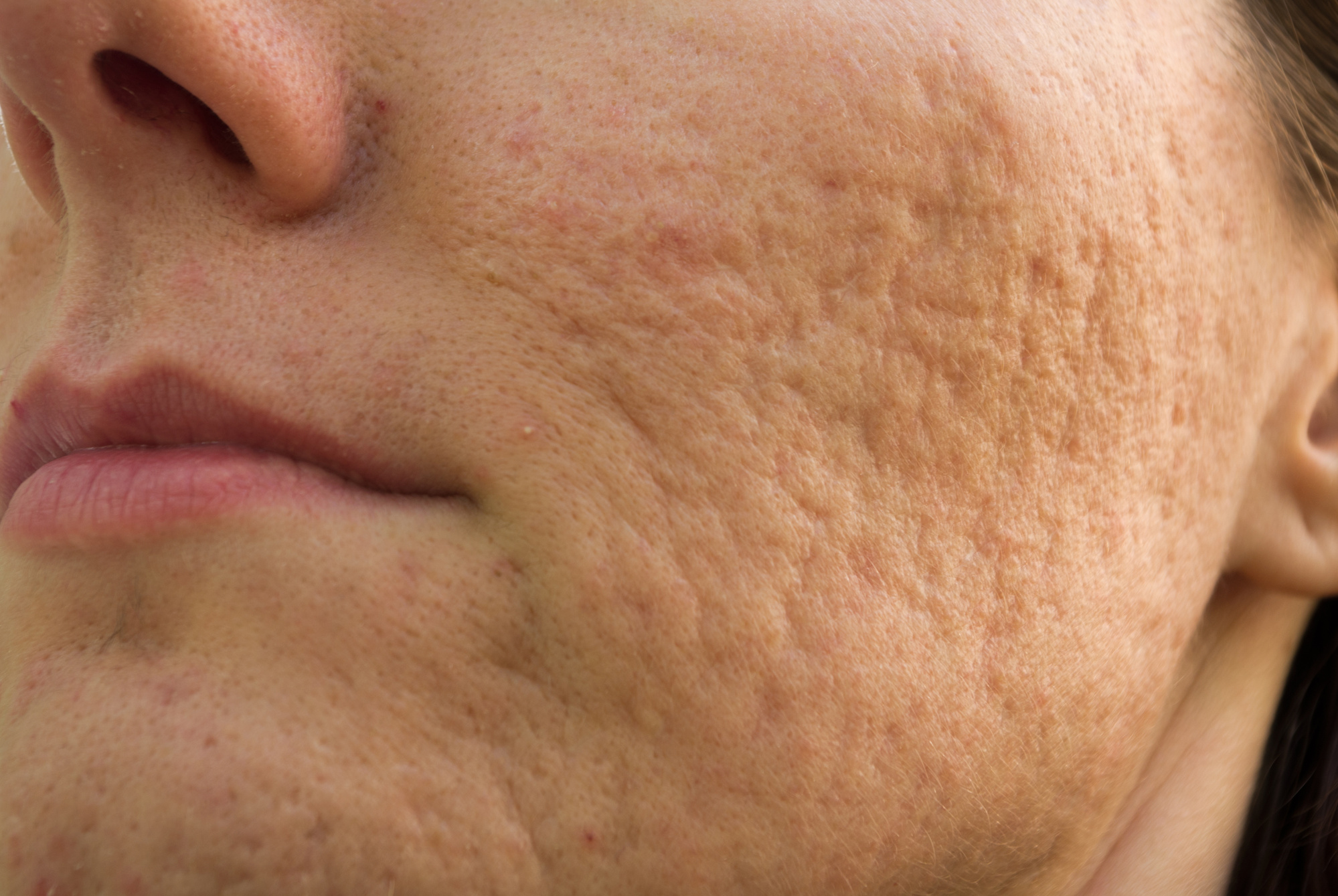 Acne scars on a woman's face