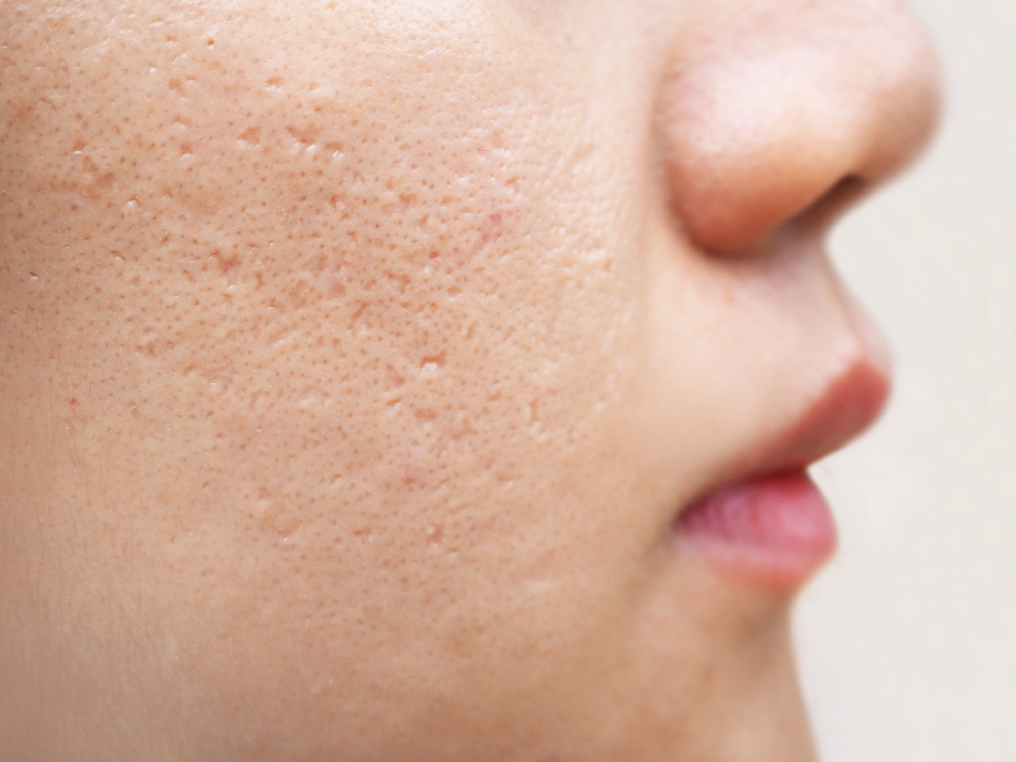 Icepick acne scars on a woman's face