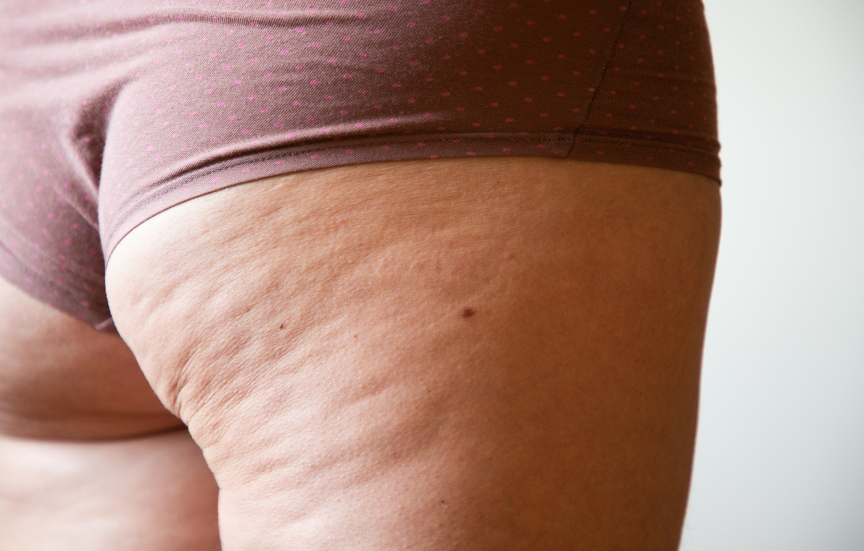 Cellulite on a woman's buttocks