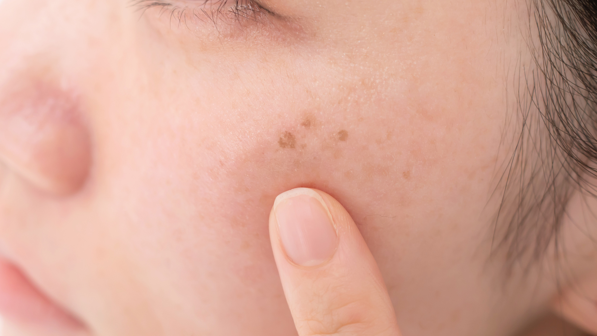 Close-up on a hyperpigmentation spot on a woman's face
