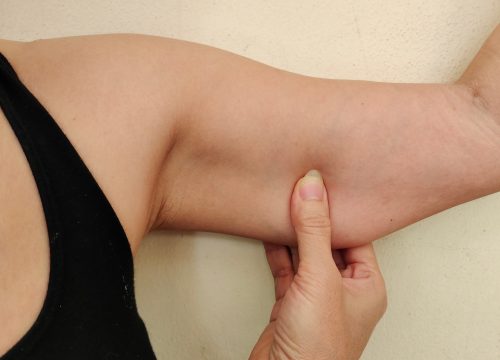 Photo of a woman's arm with loose skin