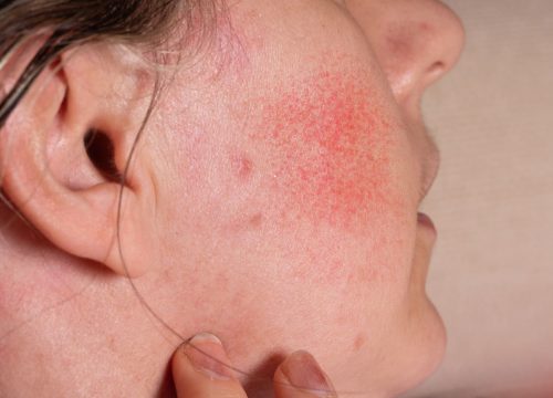 Photo of rosacea on a woman's cheek