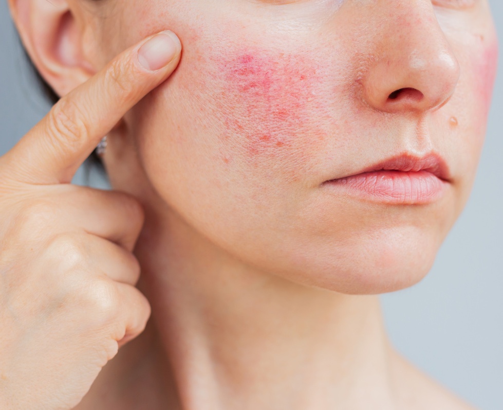 Photo of a woman pointing at the redness on her face
