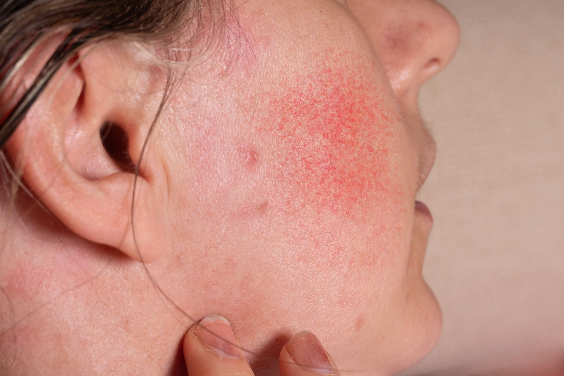 Photo of rosacea on a woman's cheek
