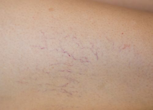 Close-up photo of spider veins on a person's skin