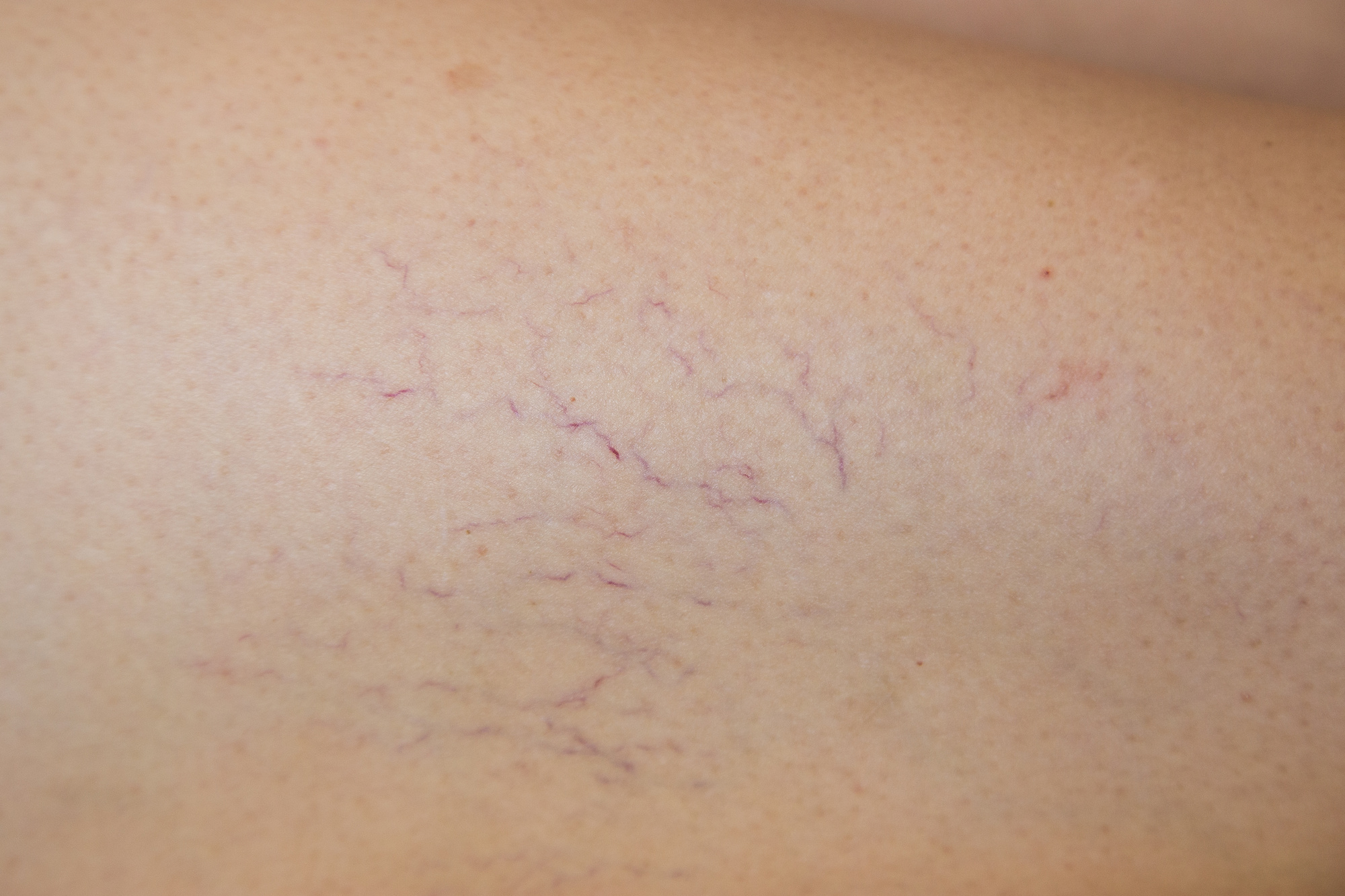 Close-up photo of spider veins on a person's skin