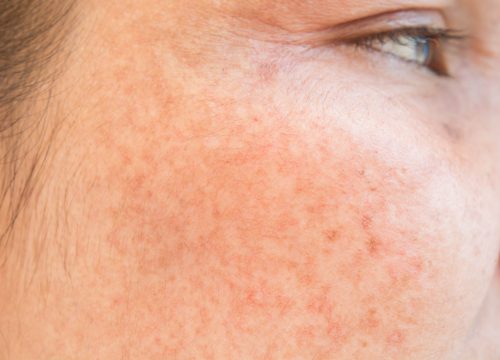 Sun-damaged skin on a woman's cheek