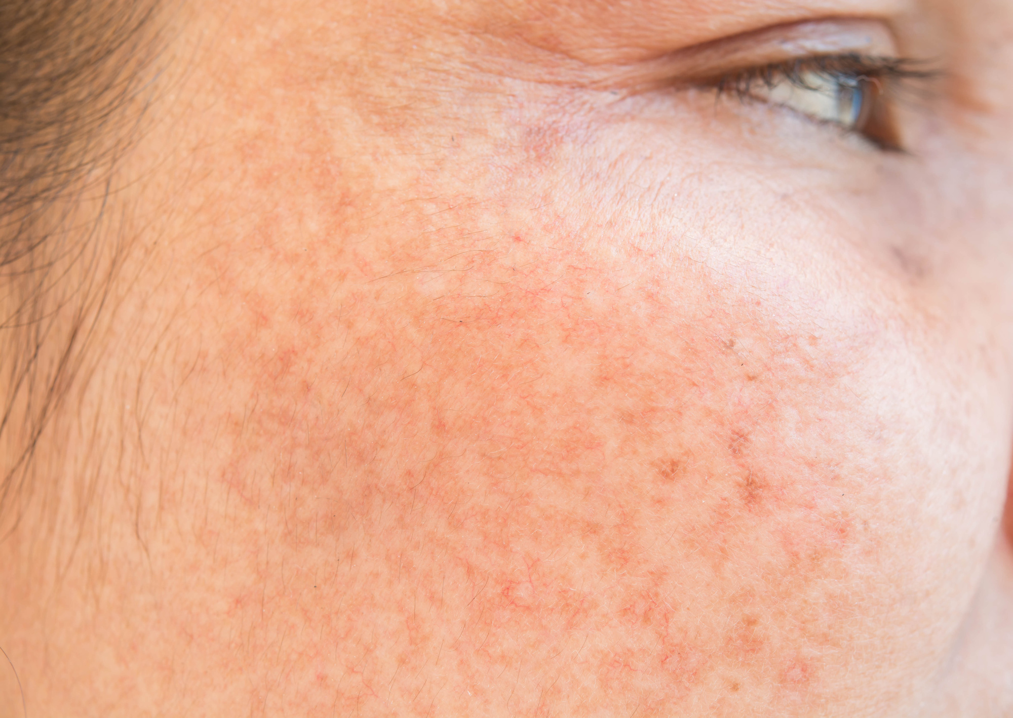 Sun-damaged skin on a woman's cheek