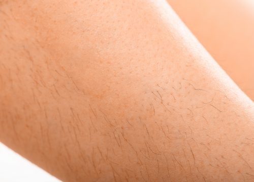 Unwanted hair on a woman's legs