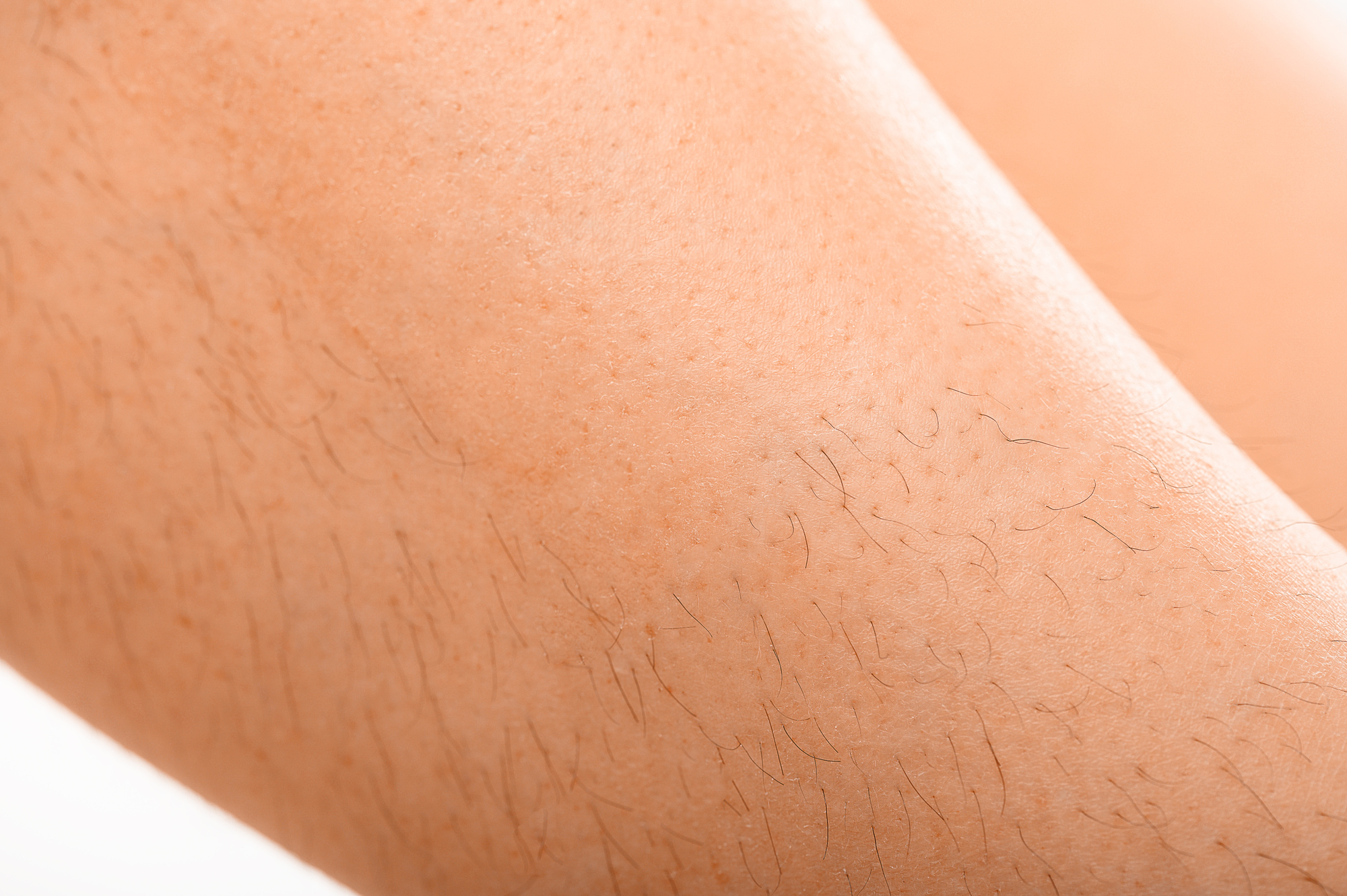 Unwanted hair on a woman's legs