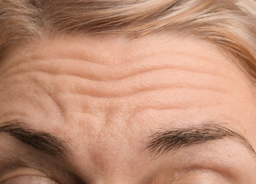 Wrinkles and folds on a woman's forehead
