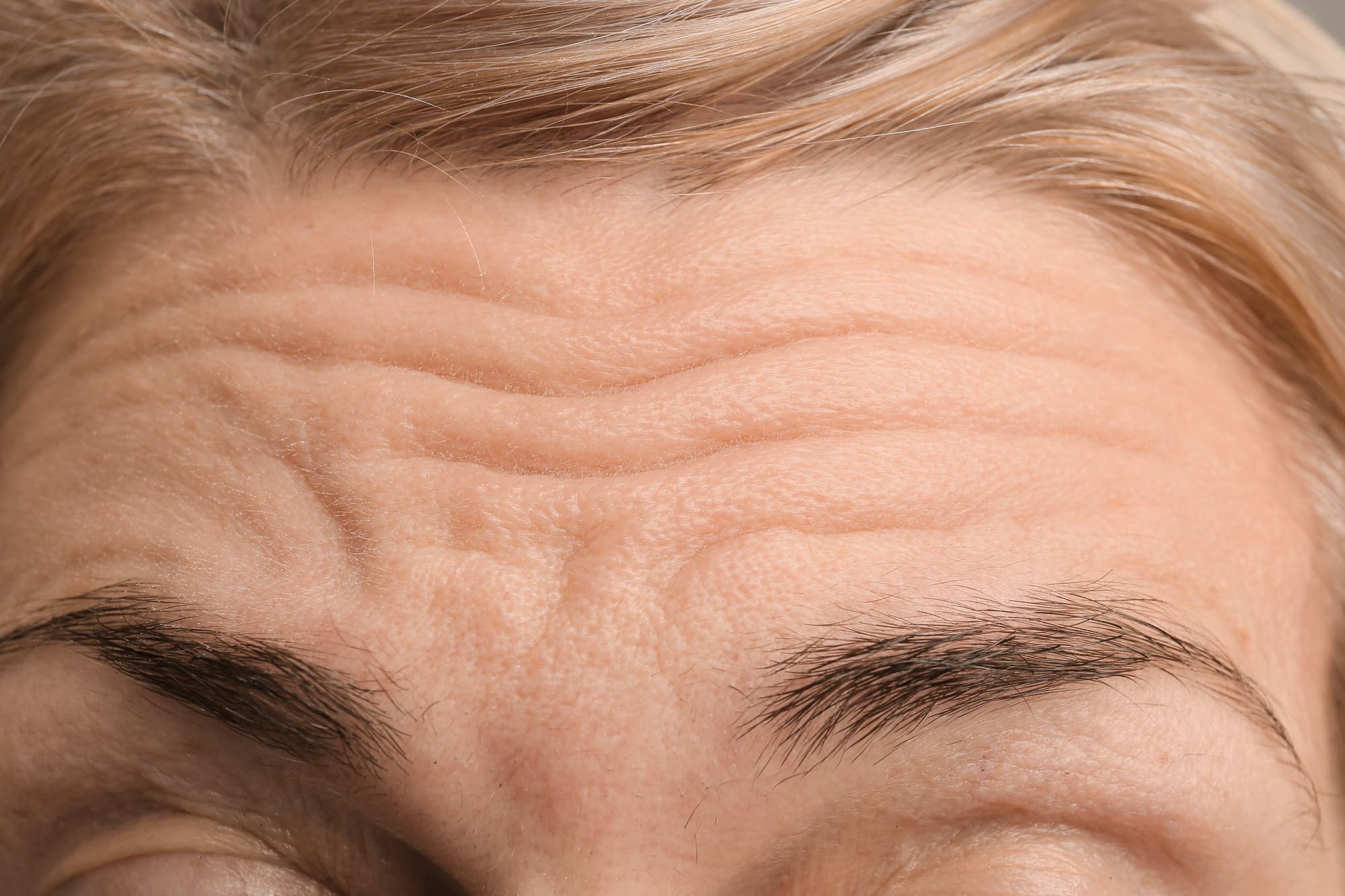 Wrinkles and folds on a woman's forehead